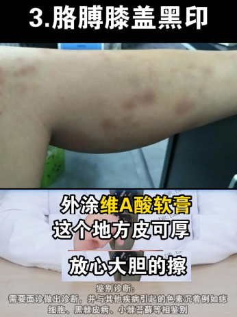 身上的黑印 去除2375 作者:小猪妖 帖子ID:79 身上,去除