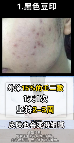 身上的黑印 去除7332 作者:小猪妖 帖子ID:79 身上,去除